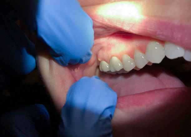 Best Chipped Tooth Repair Near Me  in Pierce City, MO